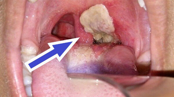 Cách phân biệt bệnh bạch hầu và viêm họng