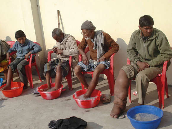 Phù chân voi (Lymphatic Filariasis) Phù chân voi (Lymphatic Filariasis)